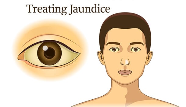 Treating Jaundice