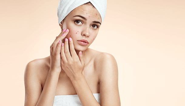 Treating Acne And Pimples
