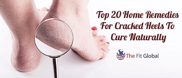 Top 20 Home Remedies For Cracked Heels To Cure Naturally