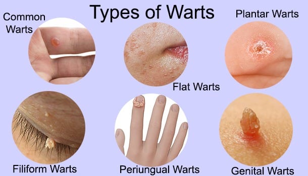Types of Warts