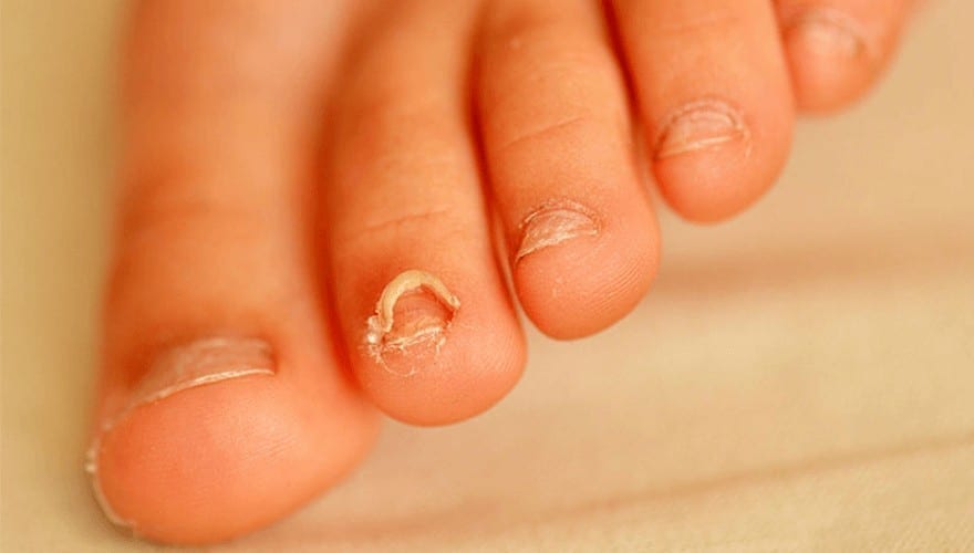 Home Remedies for Nail Fungus – Best Ways are the Natural Treatments