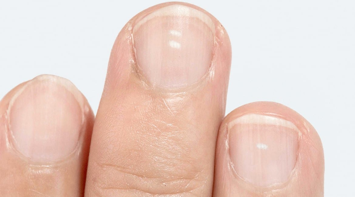 Remedies for Treating White Spots on Nails
