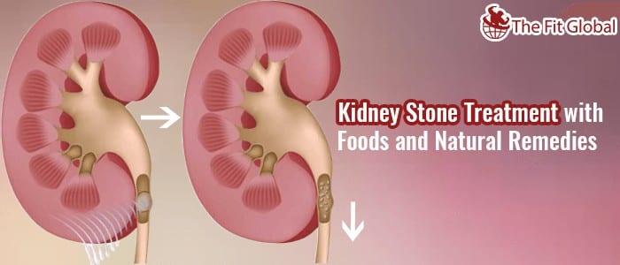 Kidney Stone Treatment with Foods and Natural Remedies