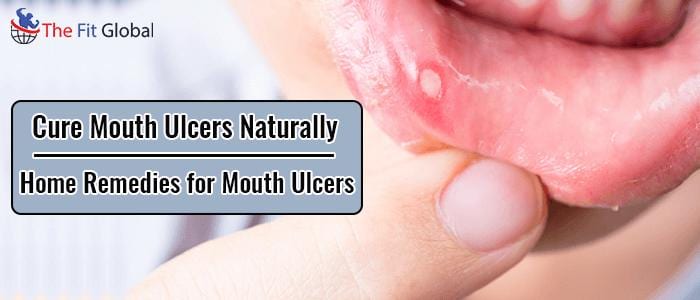 Cure Mouth Ulcers Naturally Home Remedies for Mouth Ulcers