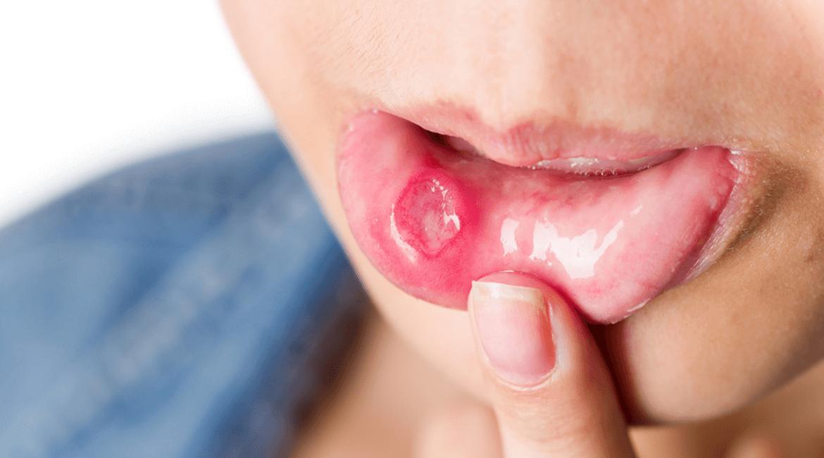 Cure Mouth Ulcers Naturally
