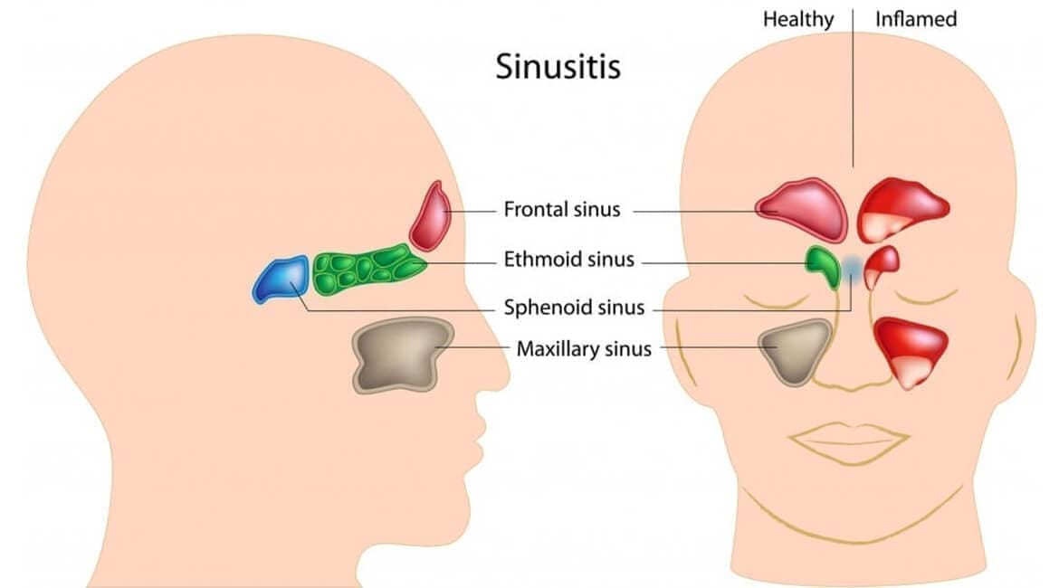 acupressure for Sinus