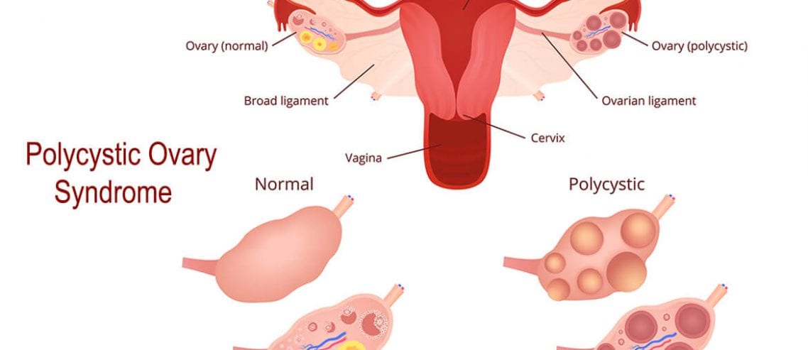 how to cure pcos naturally fast
