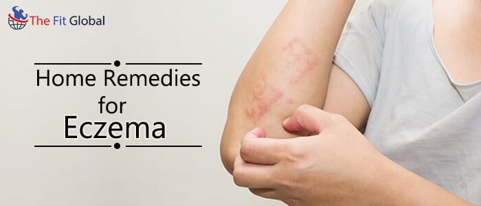 natural remedies for eczema