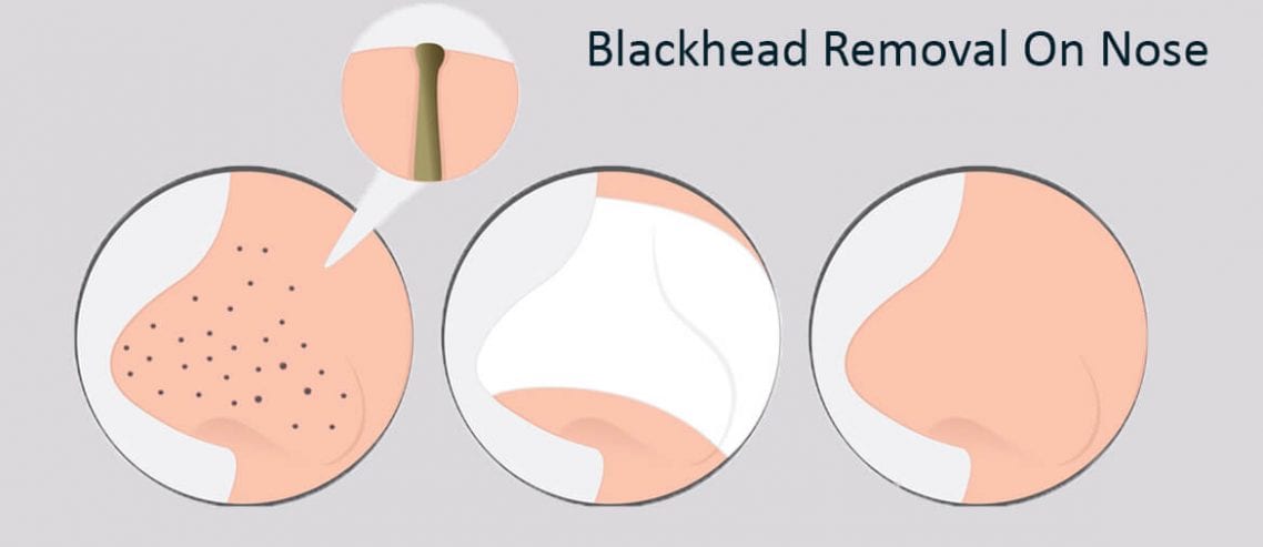 12 Natural Home Remedies for Blackhead Removal On Nose
