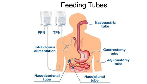 Feeding Tubes