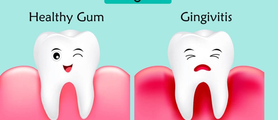 how to get rid of Gingivitis