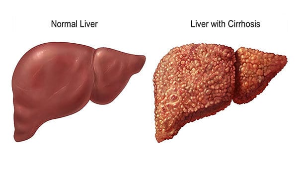 Prevents The Onset Of Nonalcoholic Fatty Liver Disease