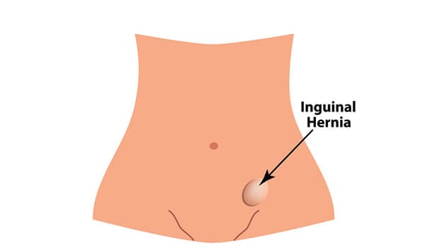 Inguinal Hernia - what causes burning sensation in stomach
