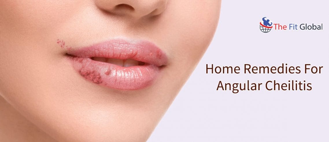 Angular Cheilitis home remedies