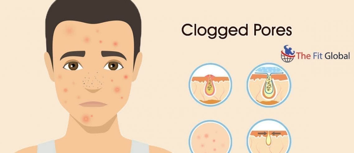 home remedies for Clogged Pores on face