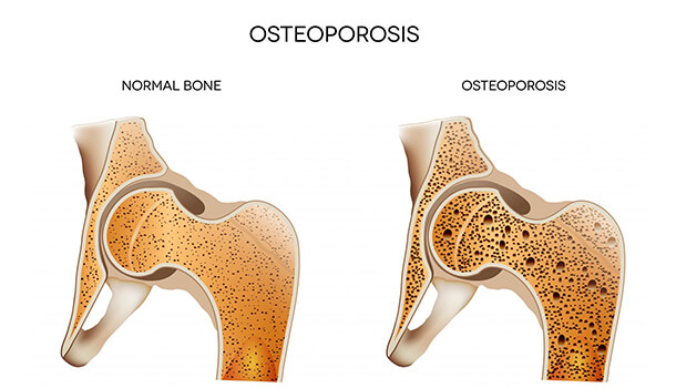 These Green Fruits Help In Osteoporosis Treatment