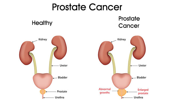 They Prevent The Chances Of Prostate Cancer