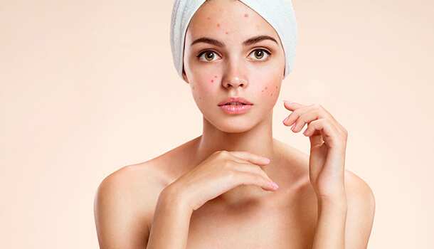 Can I use rosehip oil to treat acne