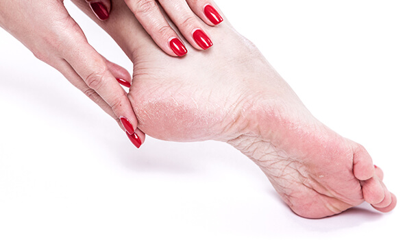 Soothe Your Cracked Heels With Rosehip Oil