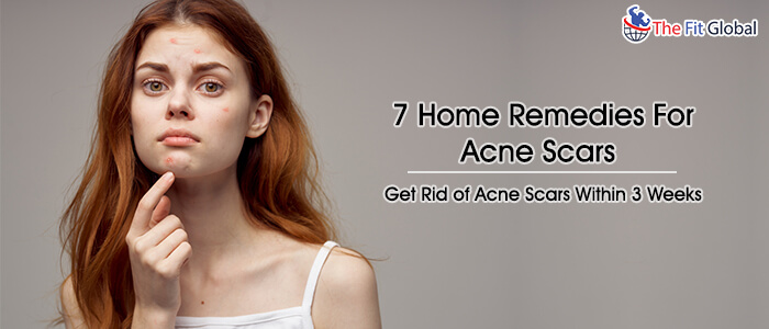 Home remedies for acne scars