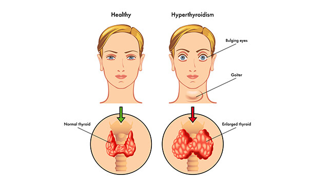 If You Are Suffering From Thyroid Issues
