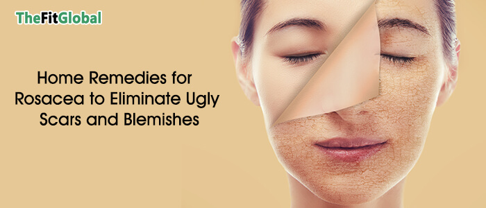 Home Remedies for Rosacea to Eliminate Ugly Scars and Blemishes