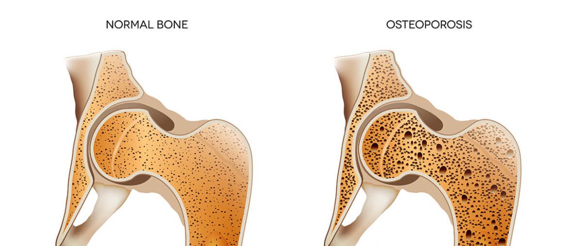 Natural treatment for osteoporosis